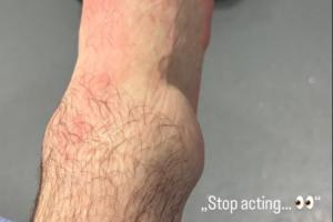 肿得跟鸡蛋一样大！利兹联中场斯塔赫晒照，脚踝被铲伤严重肿胀